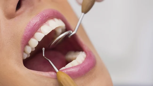 Diente caries dañado