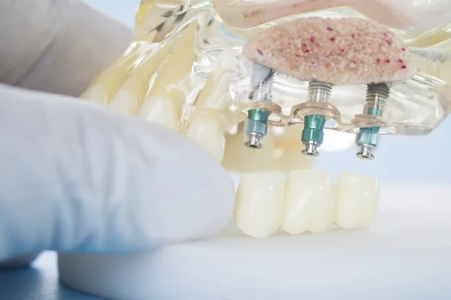Implantes dentales de carga inmediata | Clínica dental en Rociana del Condado